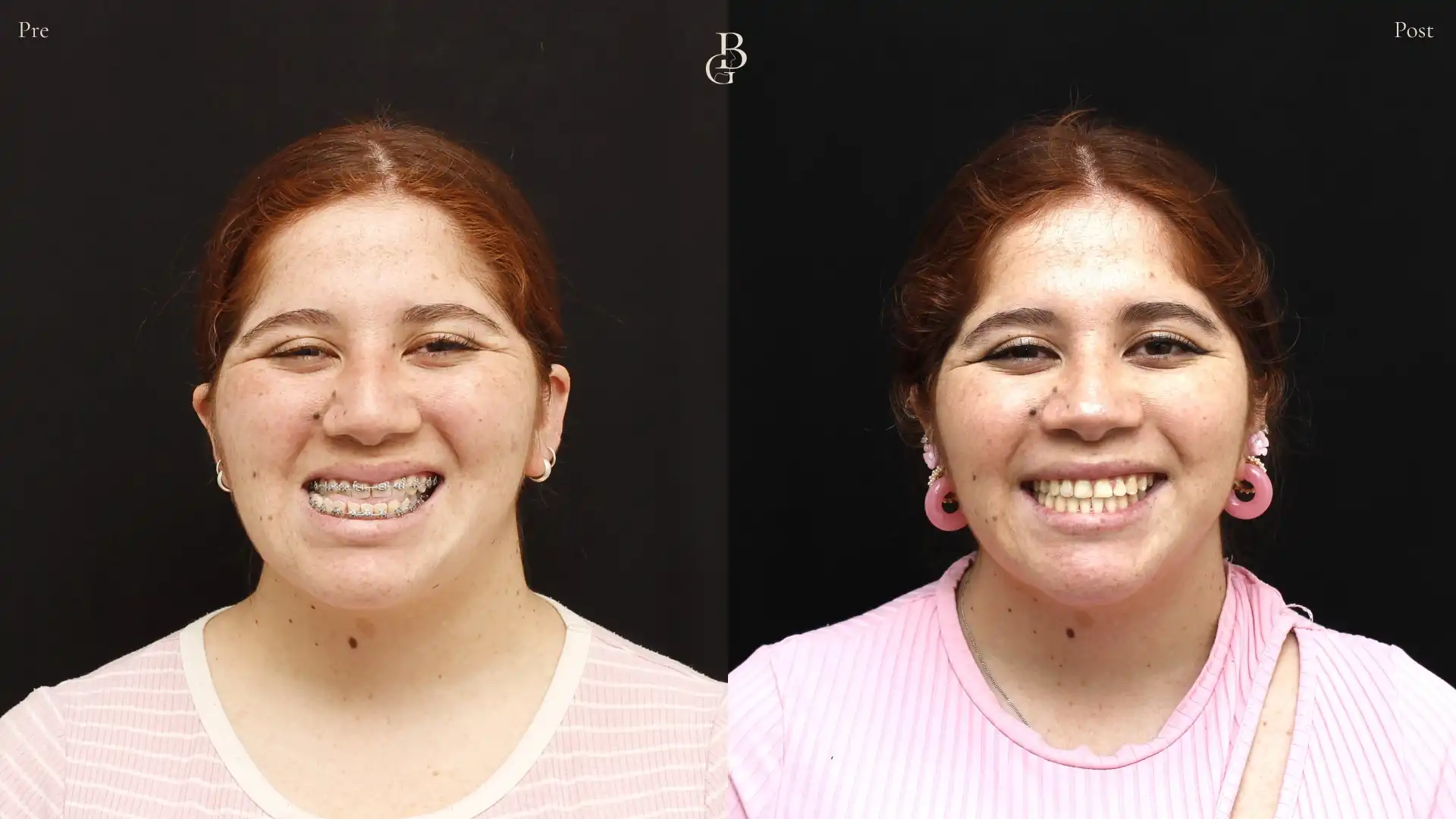 Asimatría facial pre y postop